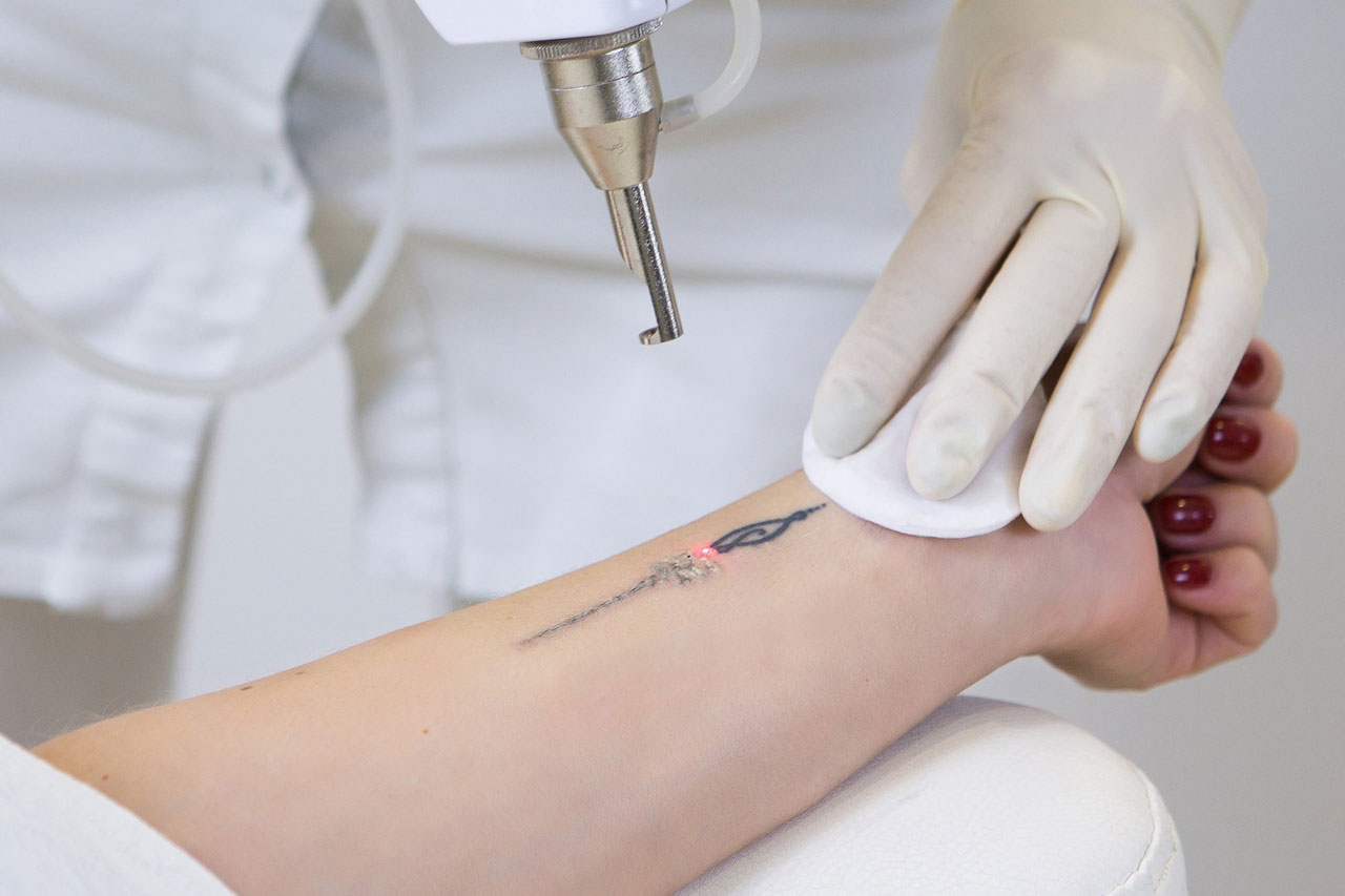 Laser para remoção de Tatuagem